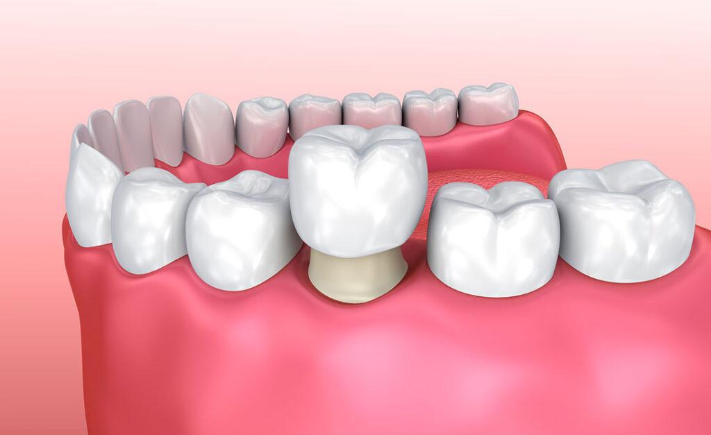 Benefits of Crowns - BlogM1.8