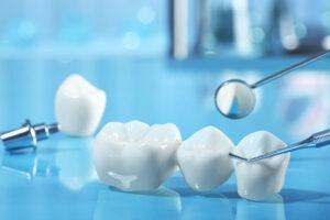 Dental Bridge - BlogM1.9