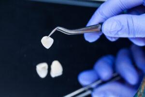 What to Expect with Veneers