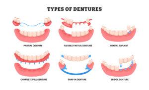 Modern Dentures Look and Feel More Natural